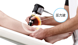 3ステップの基本治療(3)<br>圧力波によるポイント刺激
