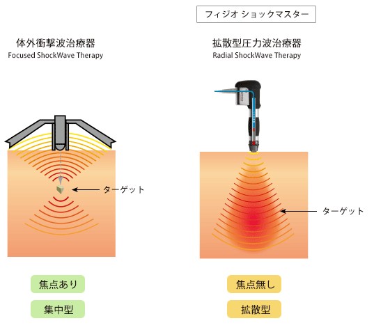 ショックマスター治療装置