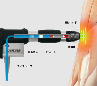 ショックマスター治療装置